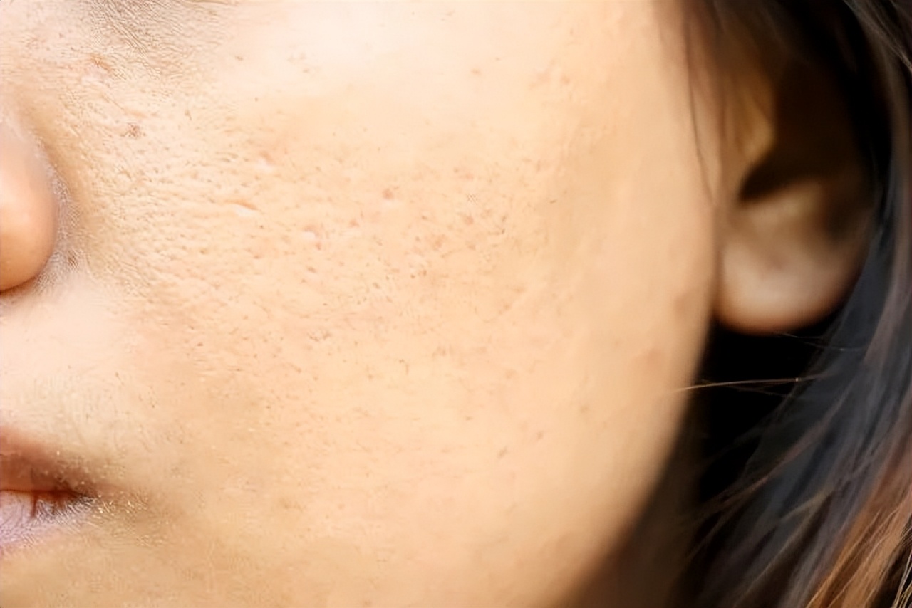 拯救毛孔粗大小妙招,解决毛孔粗大简单有效的方法