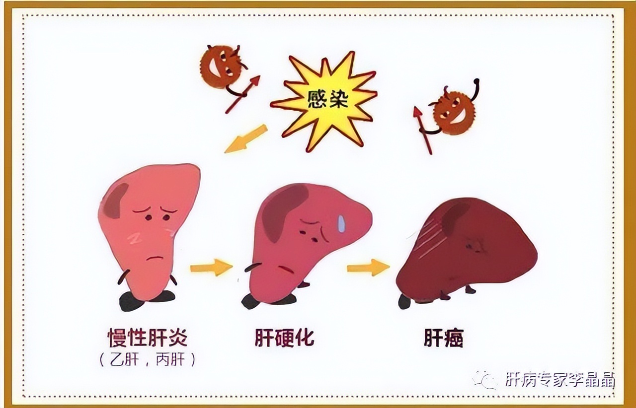 小三阳患肝硬化的几率有多大,乙肝小三阳dna阴转肝硬化需要多久