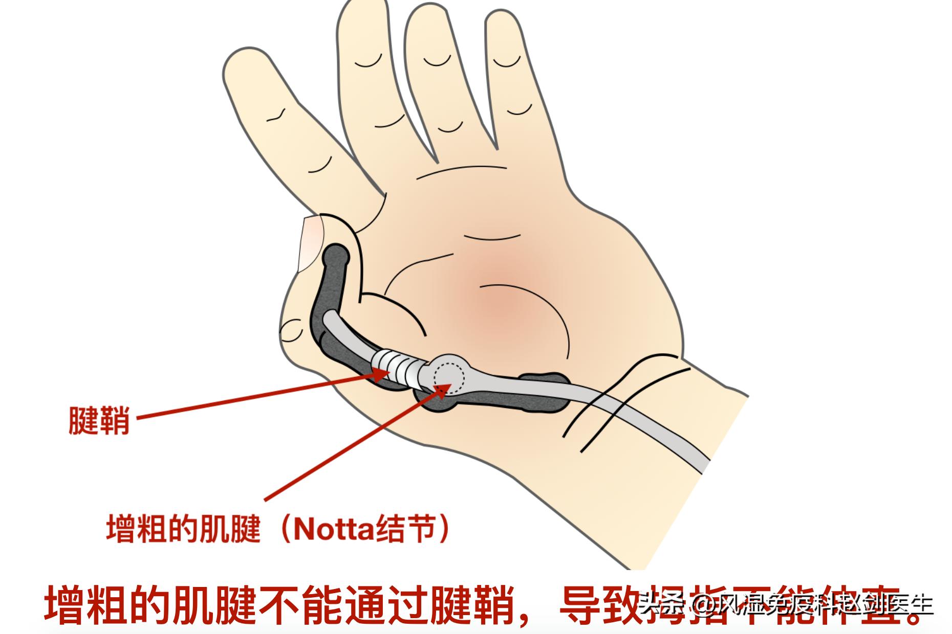 钓鱼造成手腕腱鞘炎,钓鱼导致手腕腱鞘炎