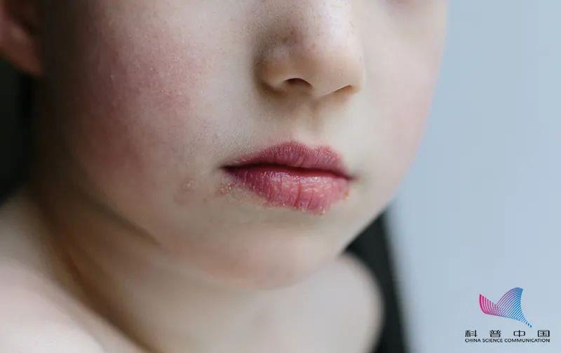 烂嘴角有什么征兆,烂嘴角是什么原因引发的