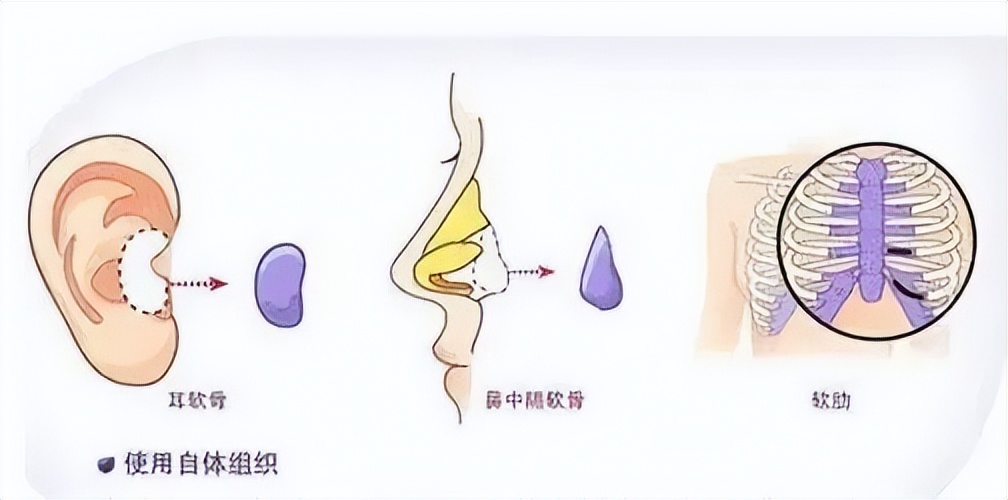 韦敏隆鼻鼻翼缩小,上海韦敏隆鼻案例