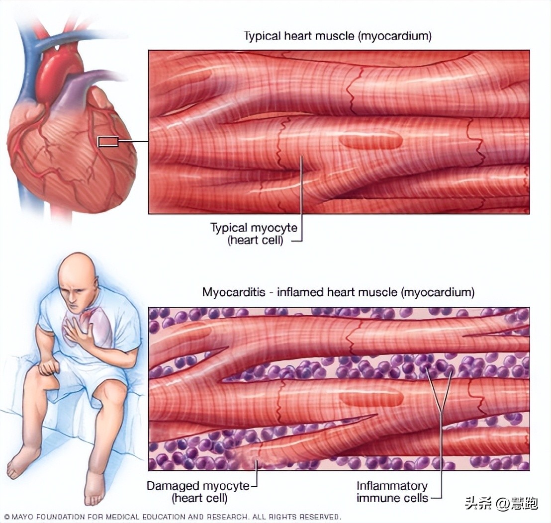 阳康后哪些运动算剧烈运动,阳康剧烈运动心肌炎能治好吗