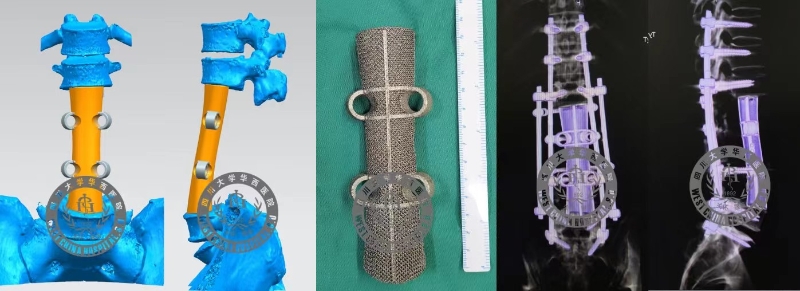 肿瘤侵犯腰大肌会怎样,恶性肿瘤侵犯腰大肌和肾