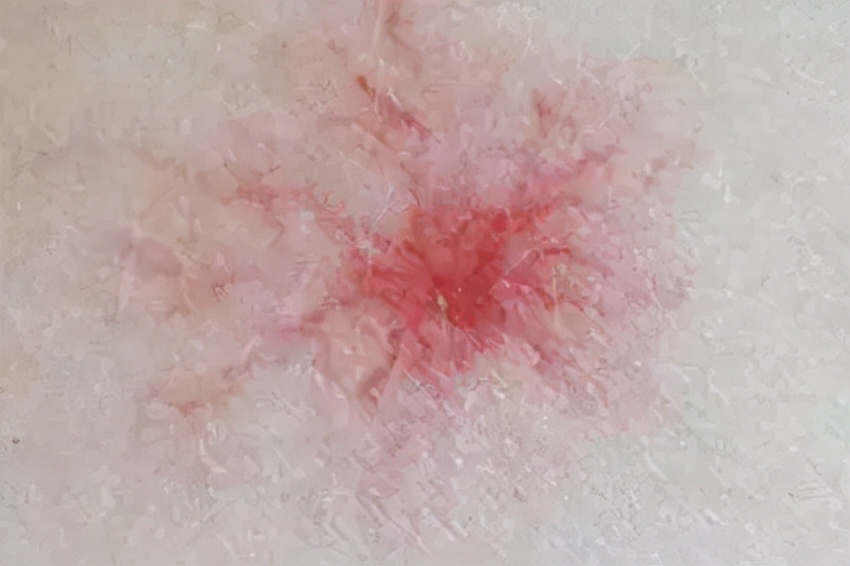 身上出现了大面积小红点不痛不痒,身上出现小红点不痛不痒什么原因