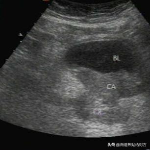 妻子绝经8年,让我给她买一包卫生巾,说月经又来了