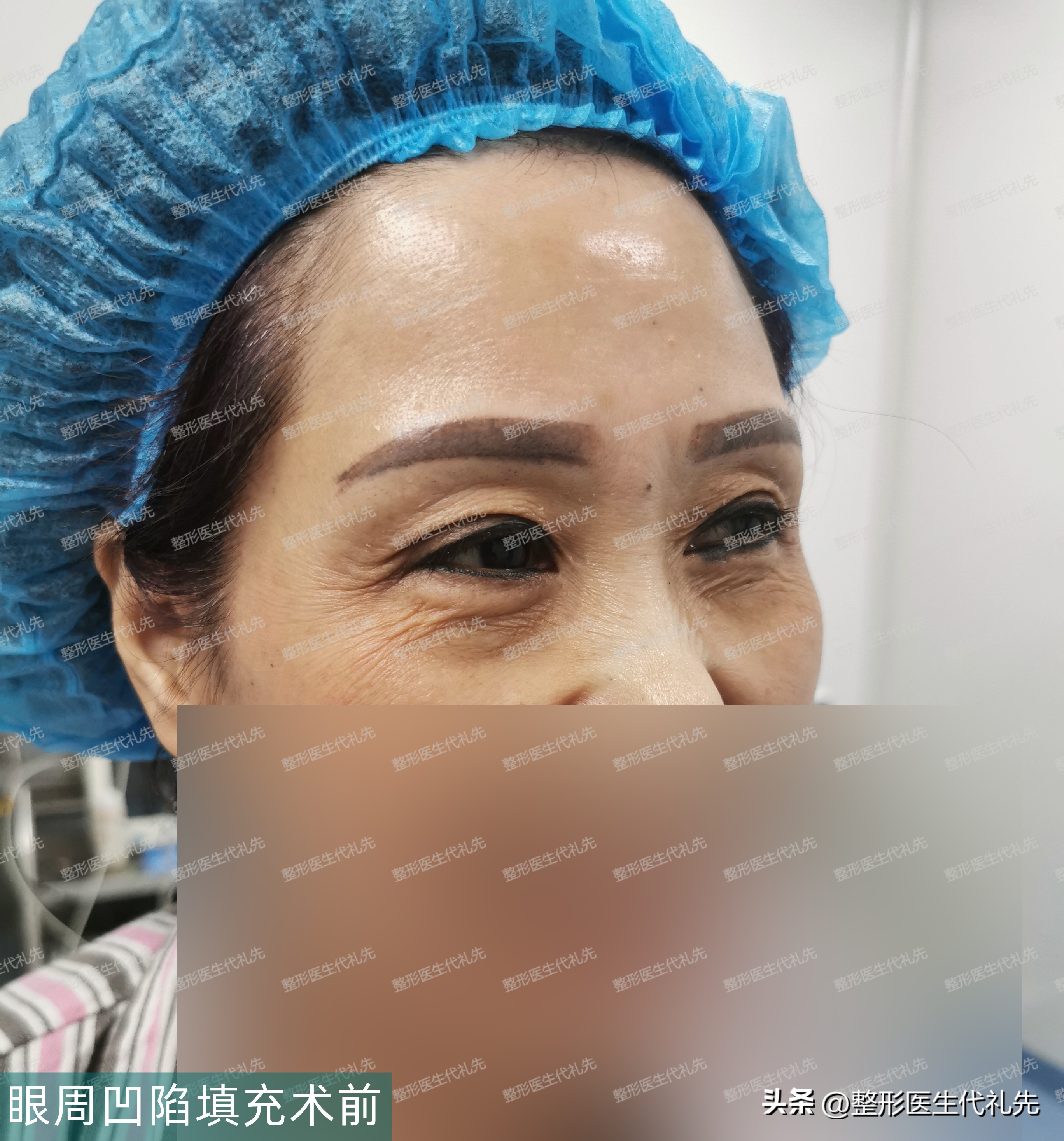 眼窝凹陷用什么填充是永久的,眼窝凹陷除了填充还有别的办法吗