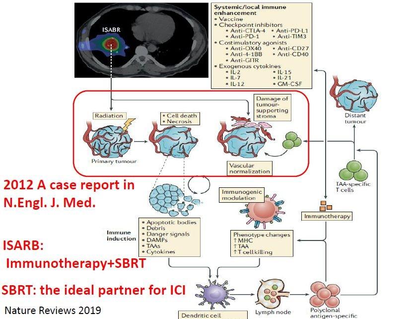 放疗联合免疫治疗肾癌,晚期癌症化疗加免疫治疗效果怎样