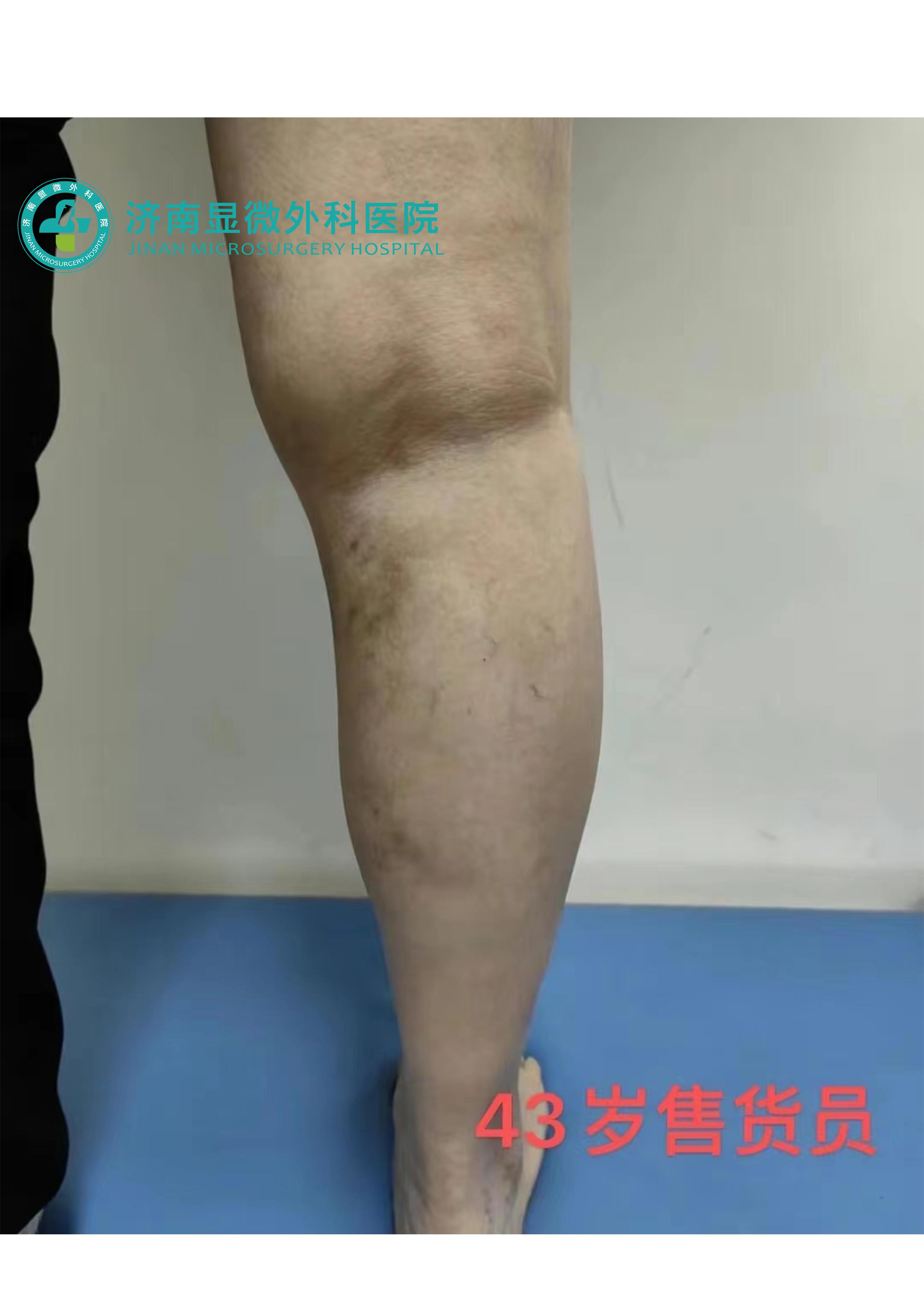 静脉曲张去哪里治疗效果最好,静脉轻度曲张怎么治疗最好