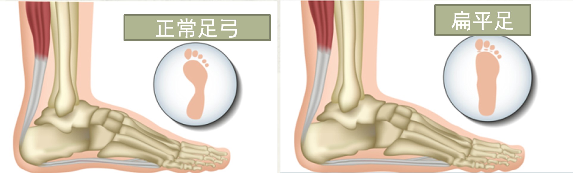 小孩子多大需要干预扁平足,8岁女孩扁平足需要干预吗