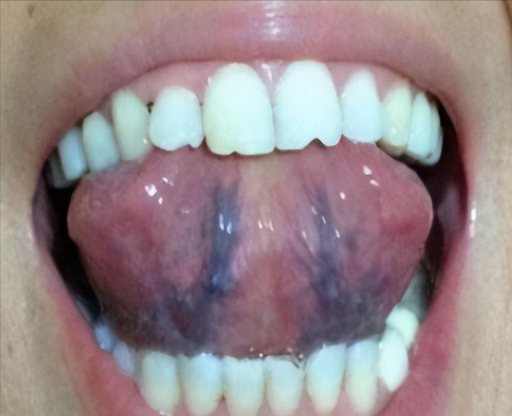 舌下有青筋就是有血瘀吗,舌下青筋是血瘀体质的症状