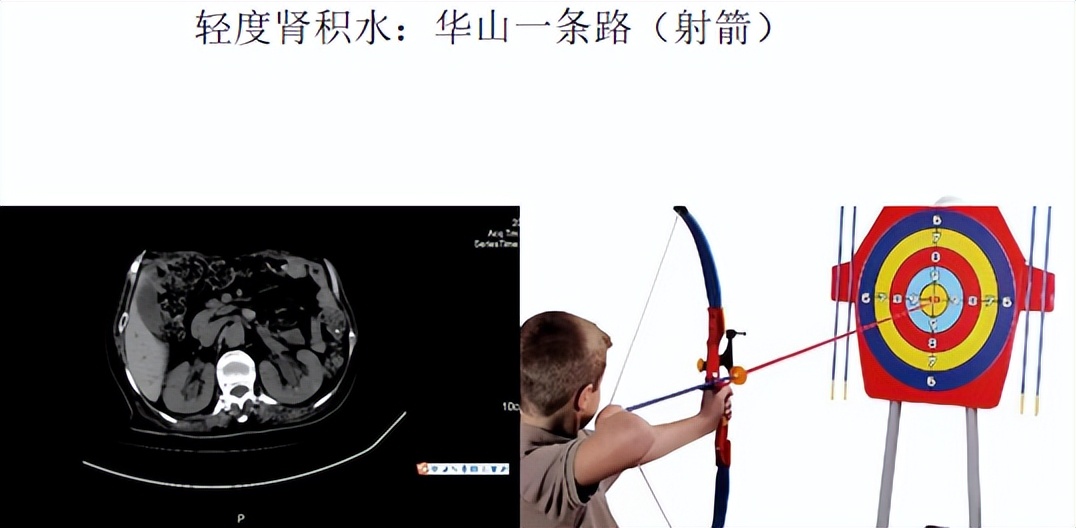 明知山有虎,偏向虎山行——肾斗士VS肾结石
