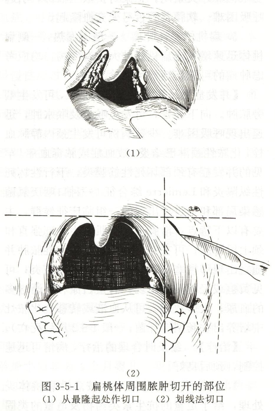 咽喉脓肿临床表现,咽旁脓肿临床表现与治疗