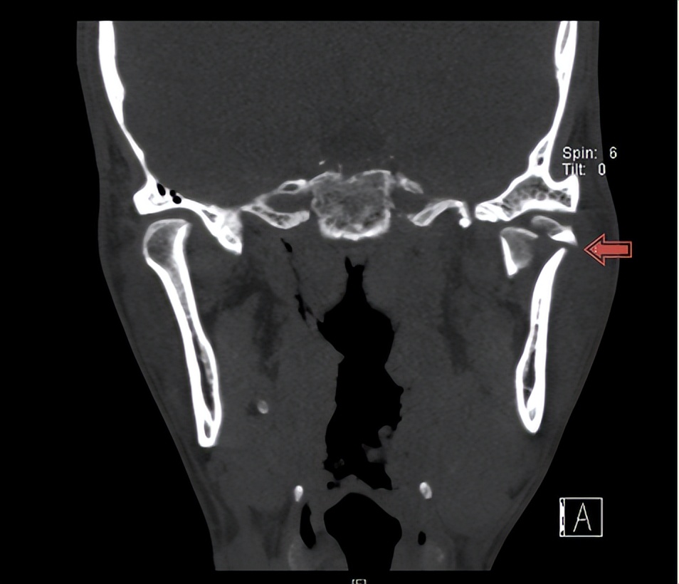 下颌骨骨折张嘴受限怎么办,下颌骨骨折后嘴巴张不开怎么恢复