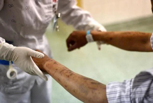 服用抗艾滋病药物cd4多久恢复,抗艾滋病毒的药漏服一次怎么办