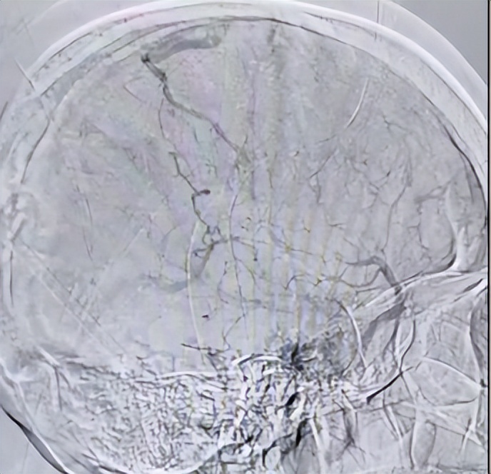 重症监护室救活孕妇故事,急救危急重症孕产妇途中分娩