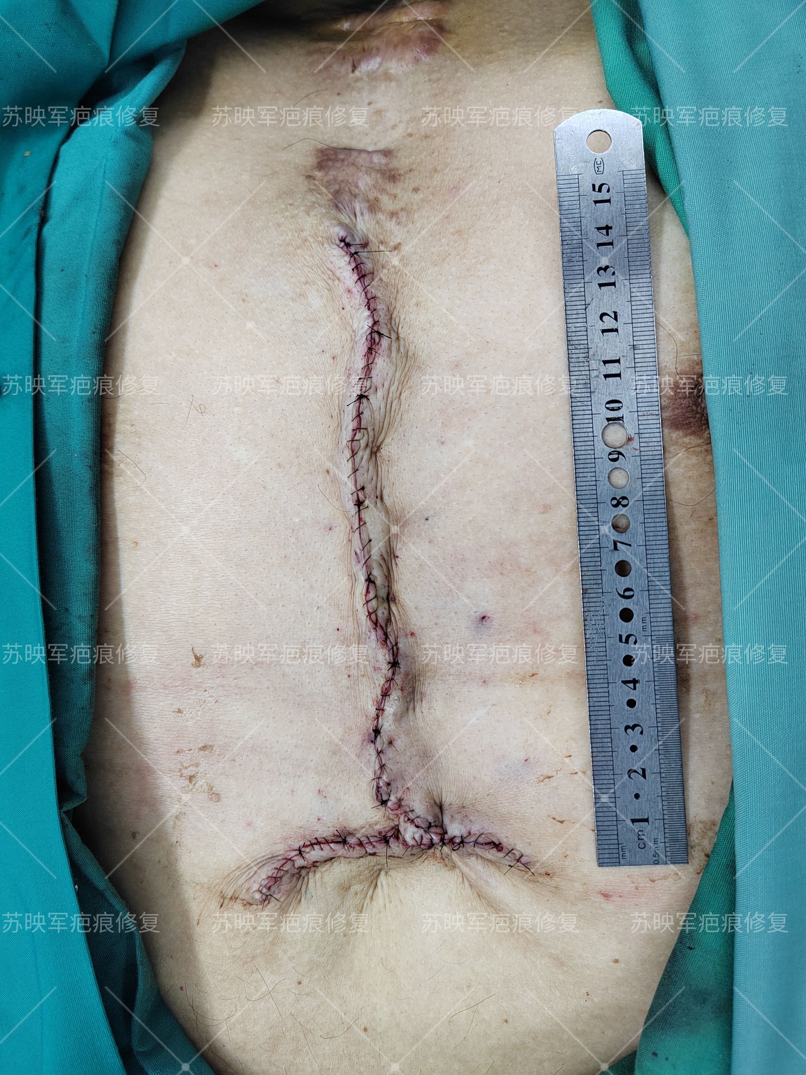 瘢痕疙瘩破溃流脓挂什么科,瘢痕疙瘩破溃怎么治疗