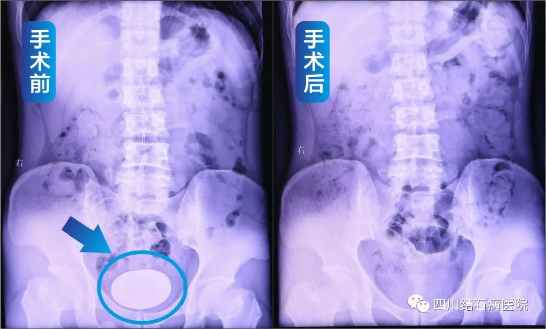 膀胱结石最大的有多大,罕见膀胱结石