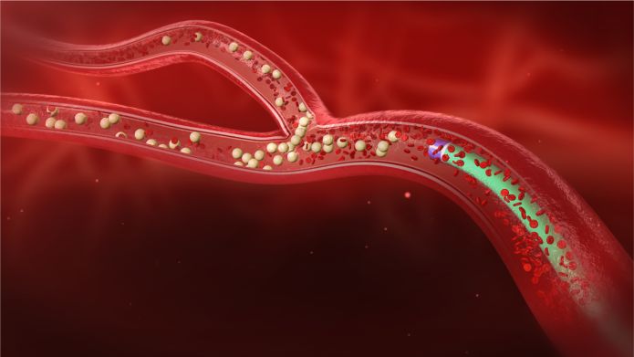 微球介入治疗肝癌的医院,河南省肿瘤医院钇90治疗费用