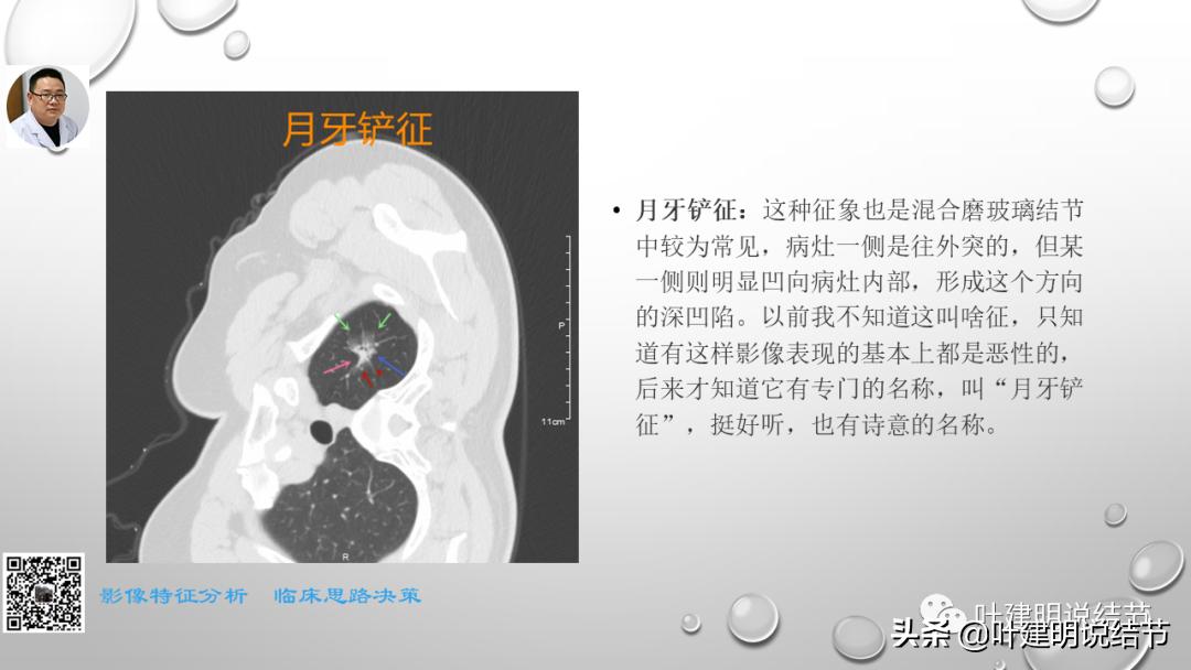 在《一脉阳光》呼吸影像诊断专题培训班上的讲课PPT（第一部分）