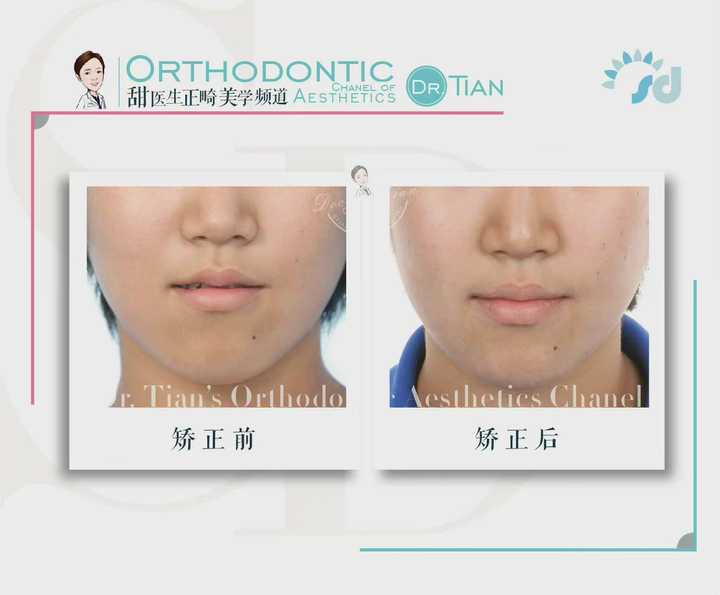 大小脸不对称改善,左右大小脸能矫正吗