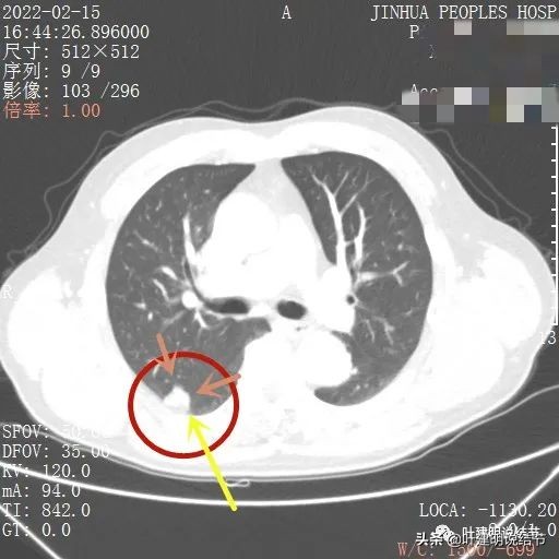 肺腺癌高危亚型什么意思,肺腺癌高危亚型