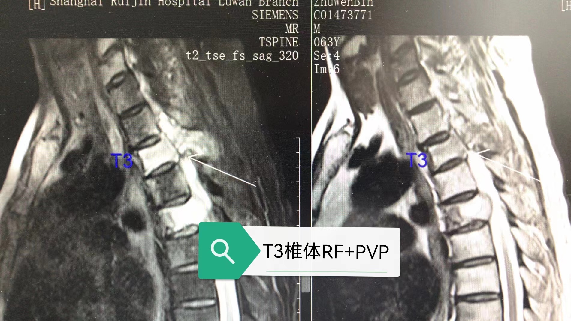 病例Ⅴ：RF+PVP联合治疗高位胸椎溶骨性转移瘤及压缩骨折