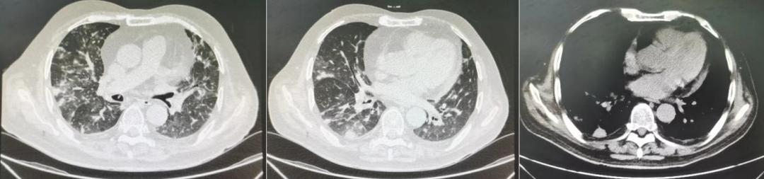 感染后稍微活动喘胸闷心悸,pjp感染