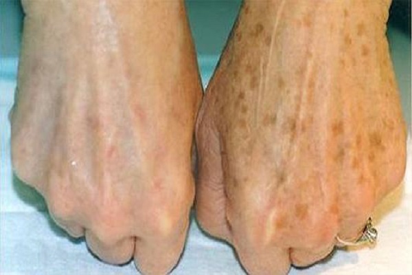 50岁长老年斑是什么原因如何去除,30多岁长老年斑是怎么形成的