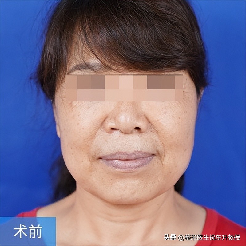 全脸拉皮手术前后的真实对比,脸部拉皮手术恢复过程图