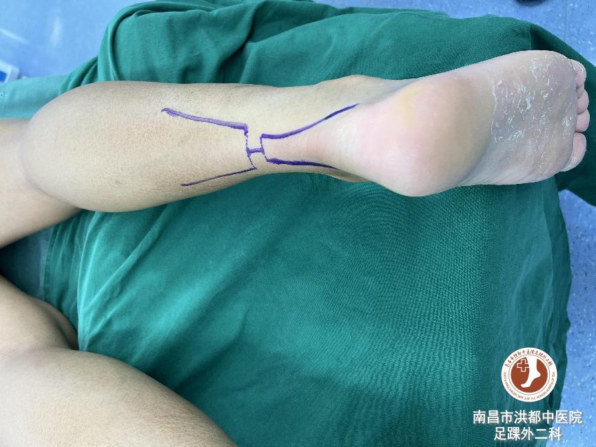 足球运动员韧带断裂修复费用,足球运动员断腿手术