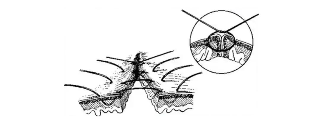 外科各种缝合方法的适用情况,外科操作缝合