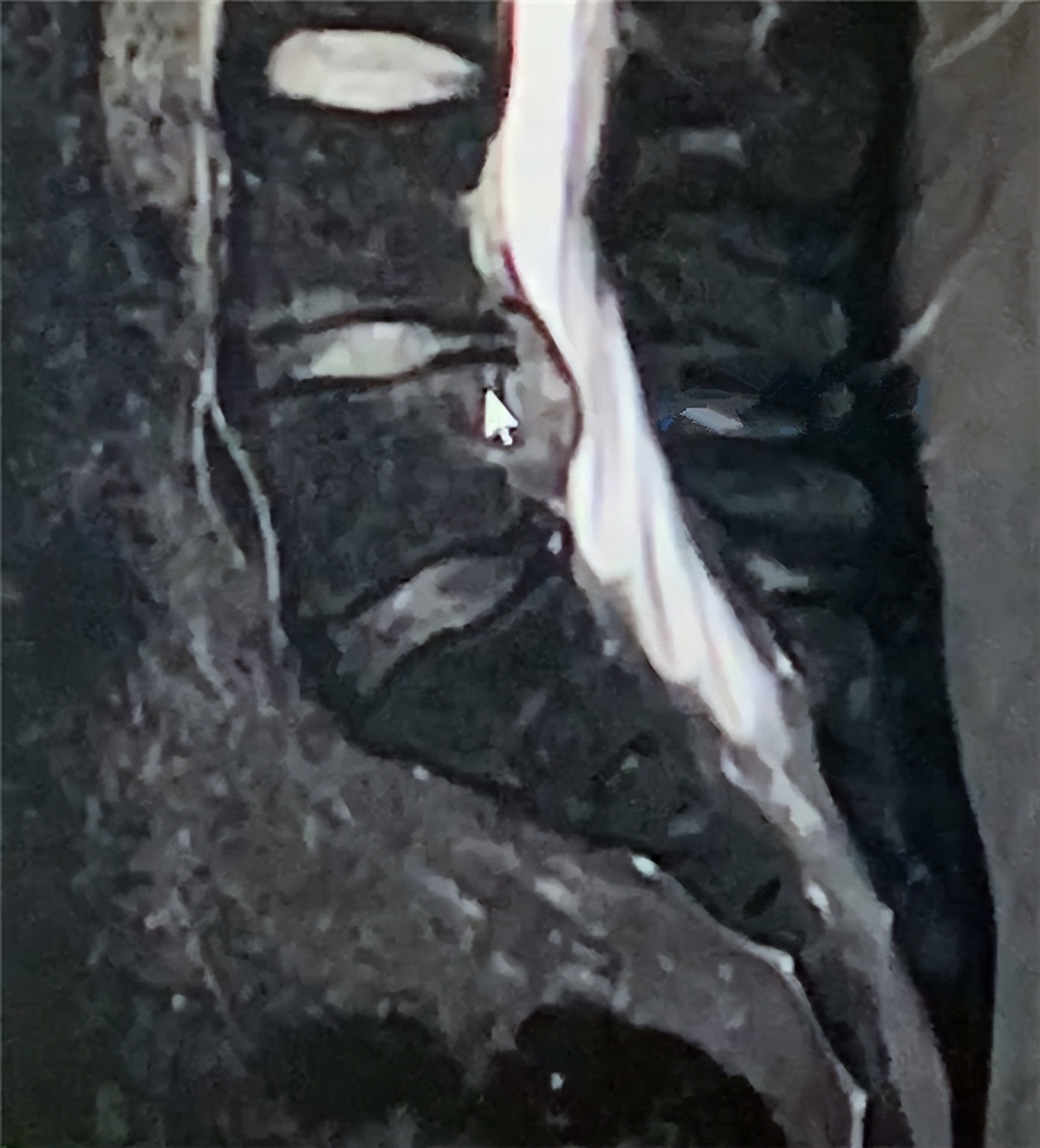 爸爸辅导作业摔断尾椎骨,父亲辅导孩子作业气晕