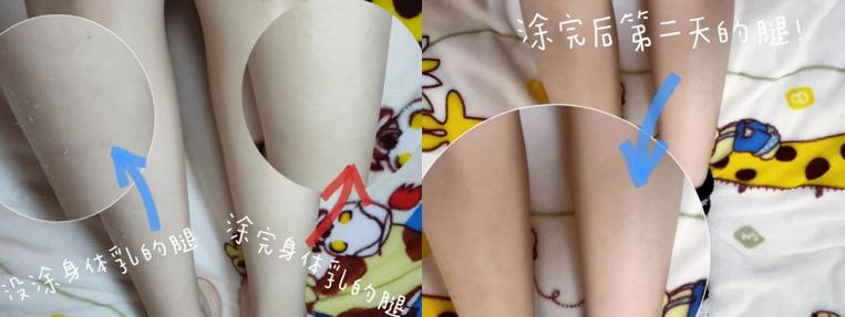 几大妙招消除产后妊娠纹你知道吗,妊娠纹肥胖纹这样淡化简单又实用