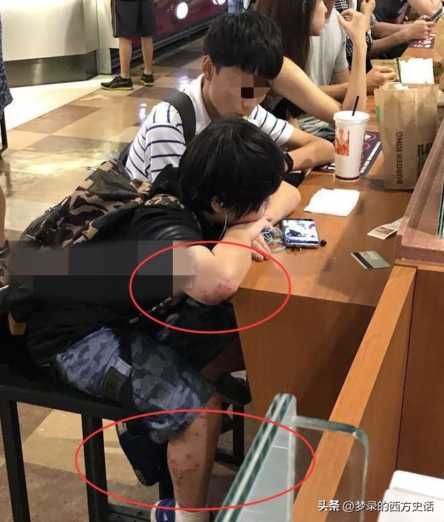 皮肤溃烂的童星,童星打促进生长激素后真实经历