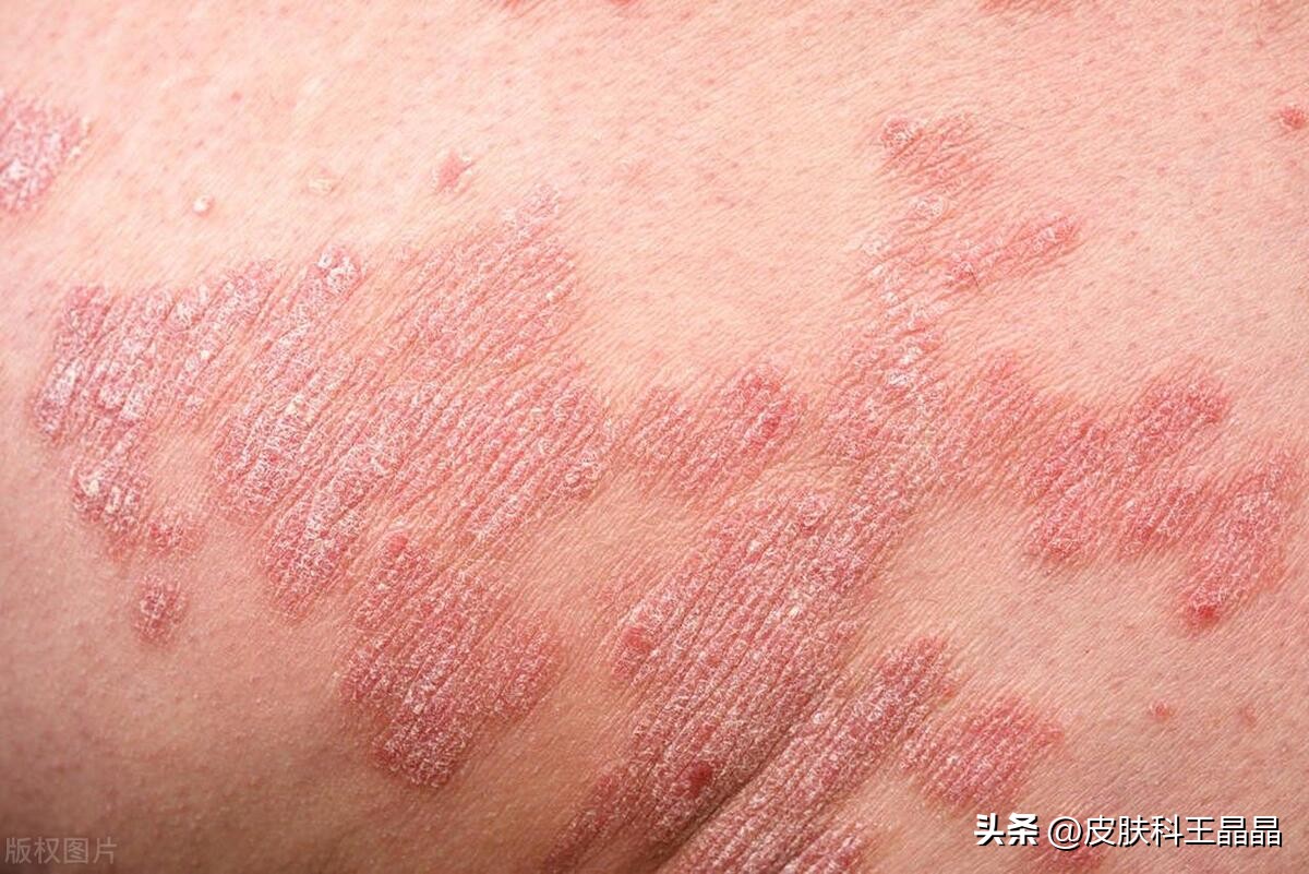 治疗牛皮癣最牛的土方治疗法,治疗牛皮癣最好最便宜的软膏