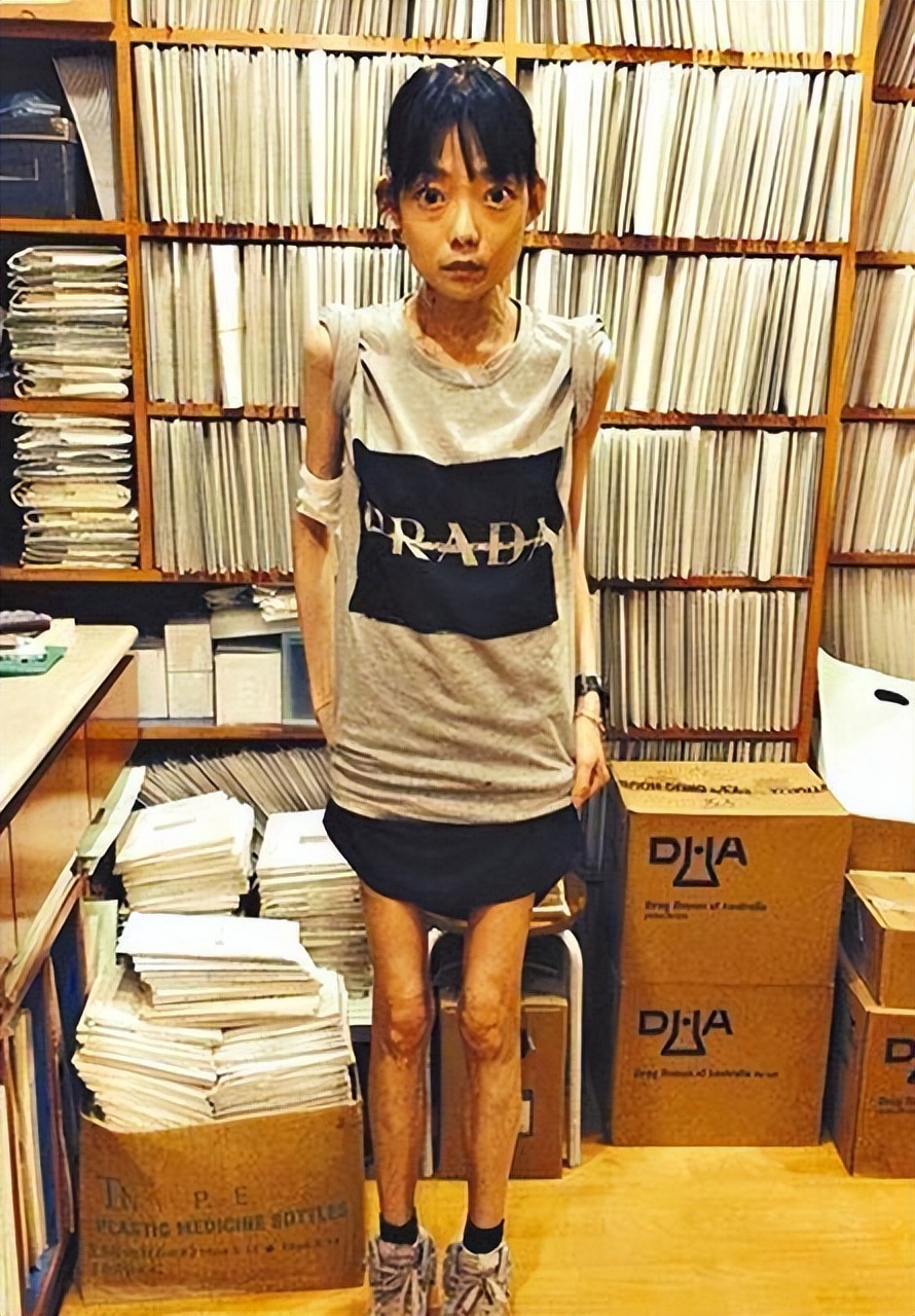 “最惨阔太”伍智恒：嫁豪门8年，换来牙齿全脱，体重仅剩44斤