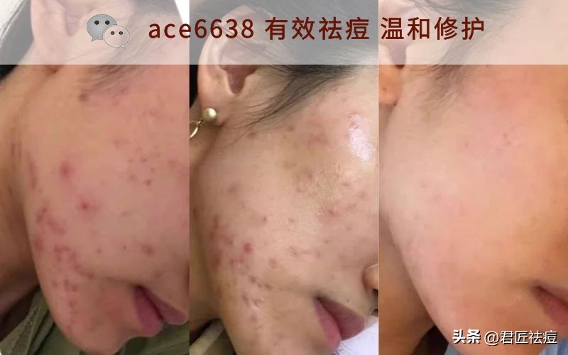 油皮痘痘怎么保湿护肤步骤,油皮怎么控油保湿祛痘