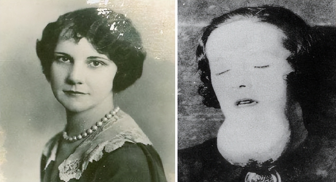 被镭辐射后的女工,核辐射后维持生命的工人