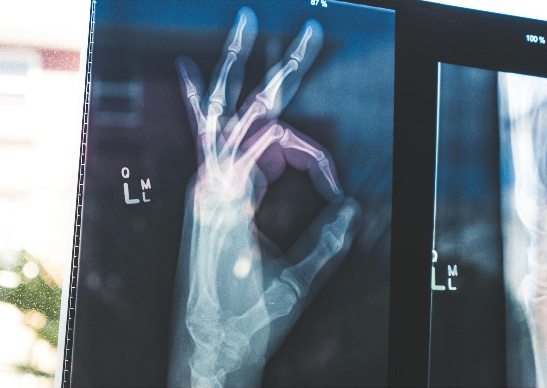 骨性关节炎最常见的关节,骨性关节炎与退变关节炎哪个严重