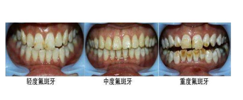 烤瓷牙好不舒服,烤瓷牙好不好看