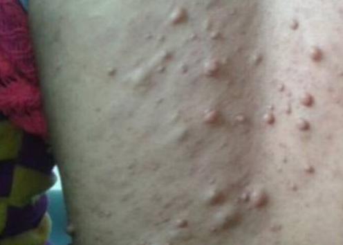 结节和脂肪瘤的病根是什么,脂肪瘤切了怎么还长