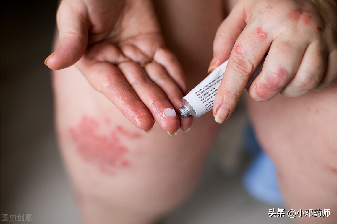 儿童银屑病擦他卡西醇会变红吗,面部银屑病能用他卡西醇