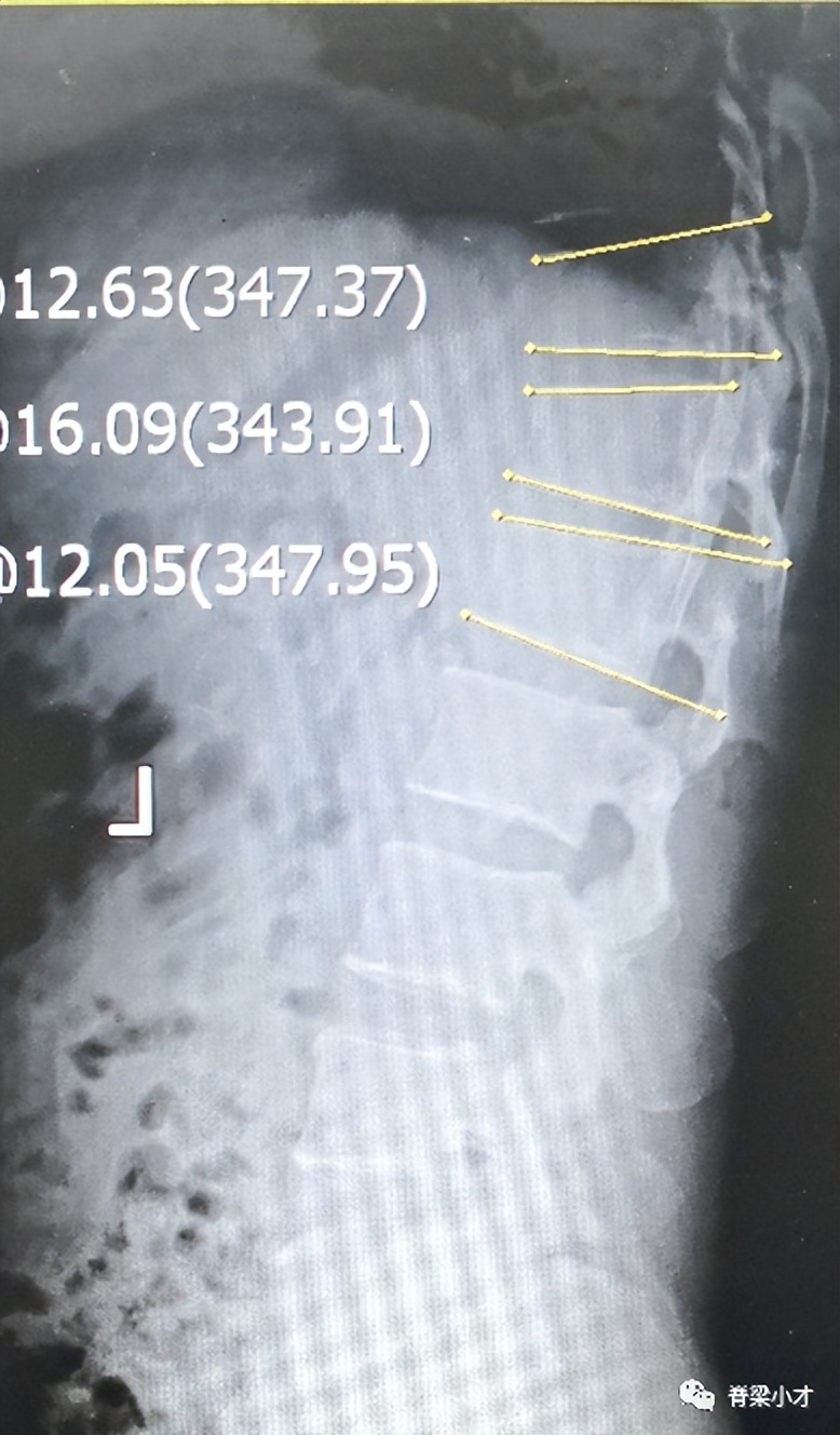 腰椎间盘突出症的诊断与鉴别,腰椎间盘突出和膨出的区别在哪里
