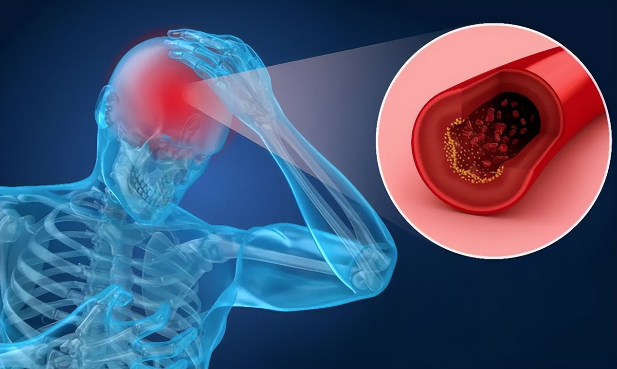 脑梗患者舌底取栓,脑梗取栓是最佳治疗方法吗