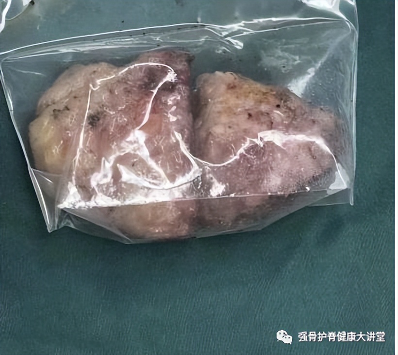 「医学科普」讨嫌的富贵包怎样形成的？怎么治疗？