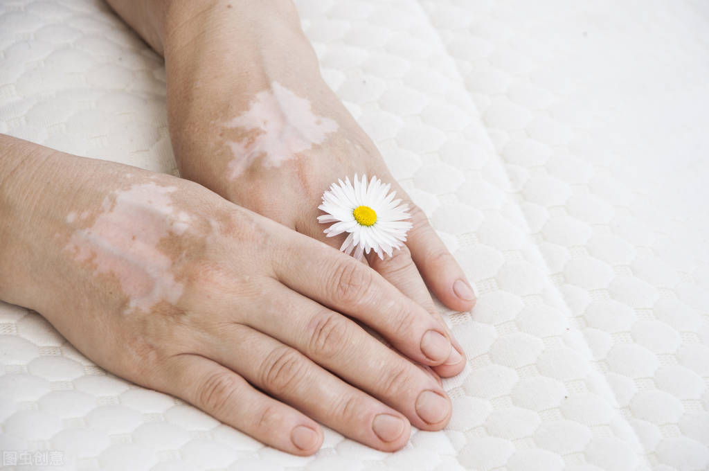 手臂白斑一直在扩散？应该这样去应对