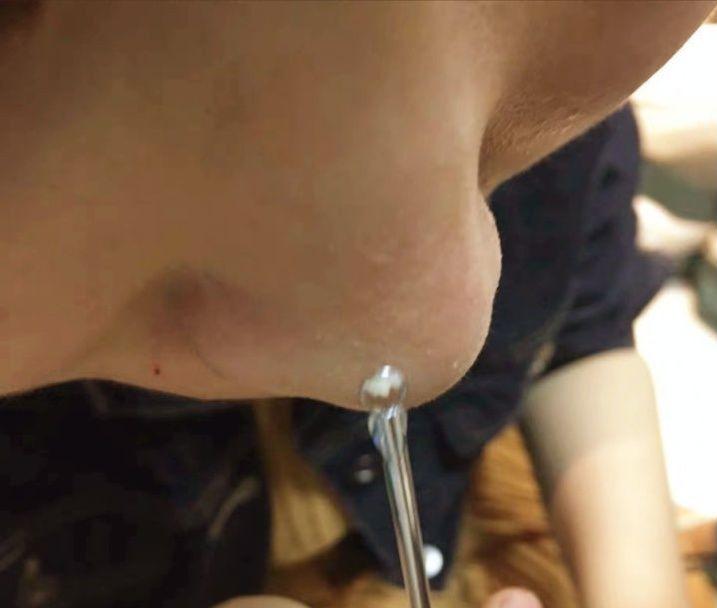 鼻子上有黑点怎么抠掉,鼻子边缘的小白点怎么去除