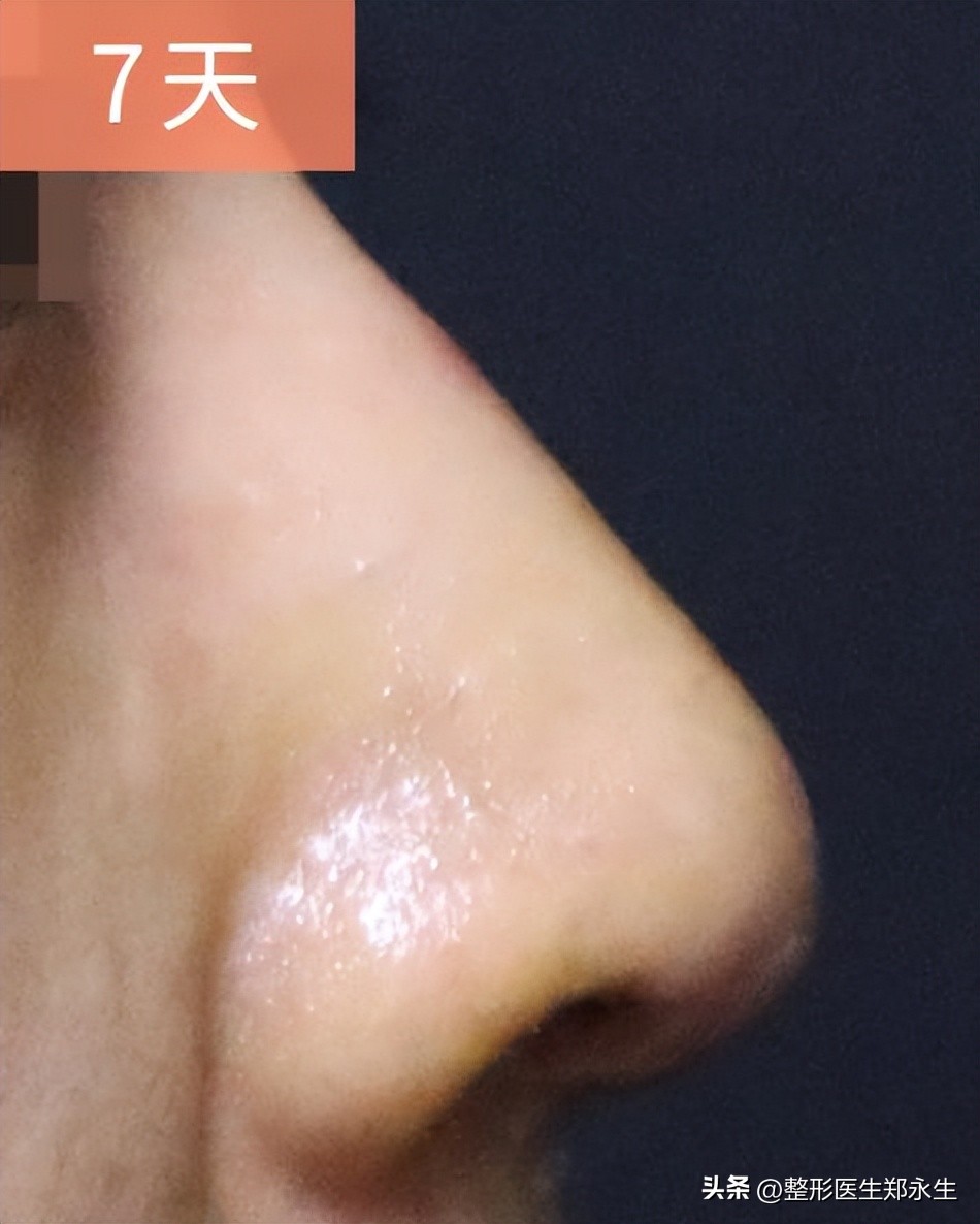 鼻子不满意在原医院修复要钱吗,鼻子坑修复最有效的方法