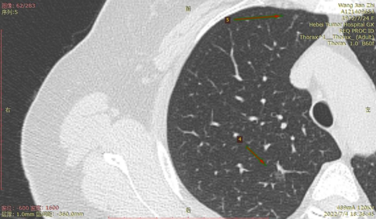 首次发现磨玻璃结节要吃药消炎吗,磨玻璃结节警惕合并占位