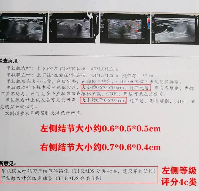甲状腺癌全切甲状腺球蛋白0.47,甲状腺球蛋白tg低多少是癌